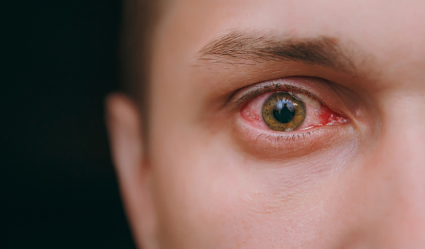 7 أسباب للعيون الحمراء كليفلاند كلينك أبوظبي