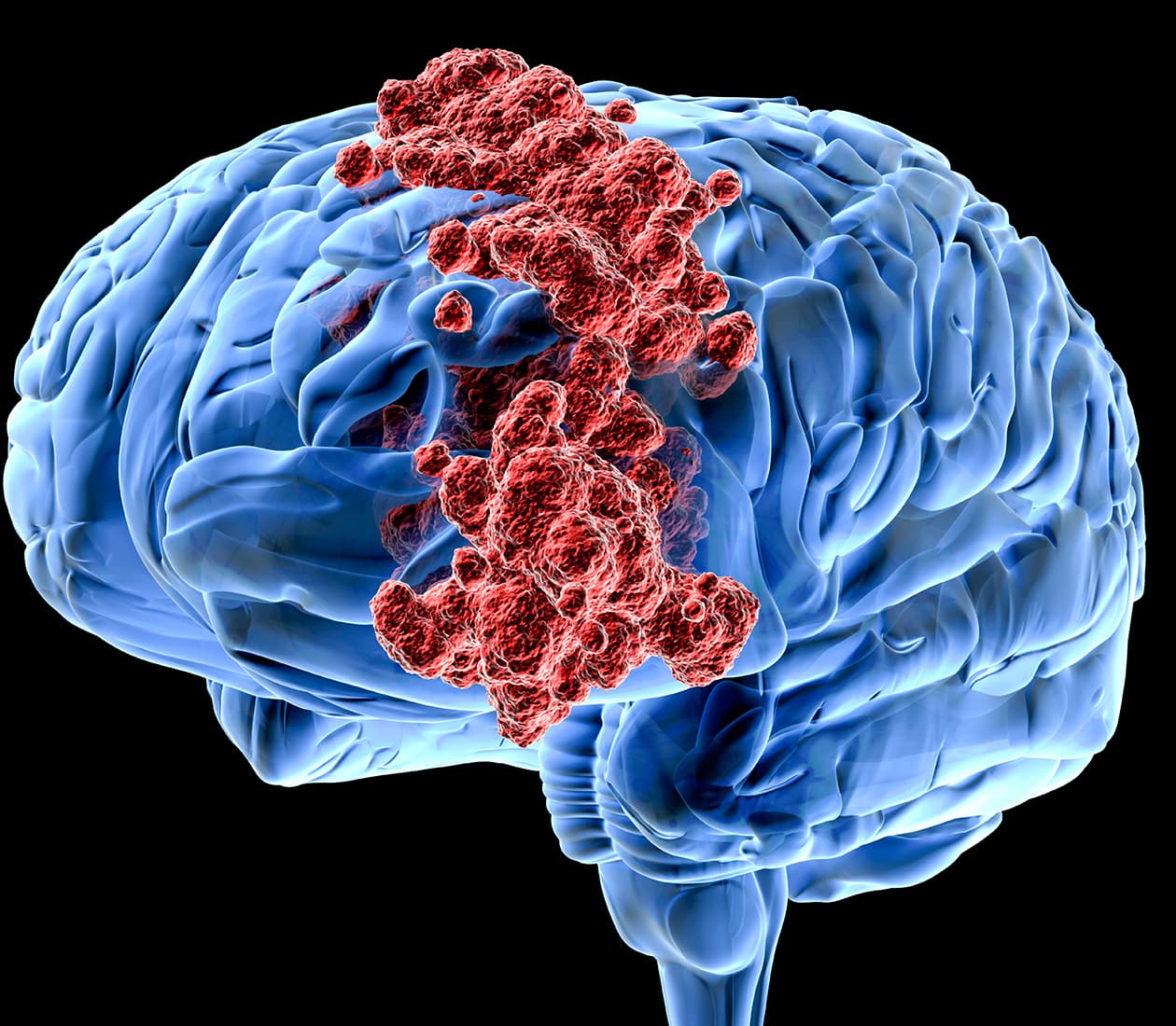 Brain and Spinal Cord Tumors: Treatment & Diagnosis